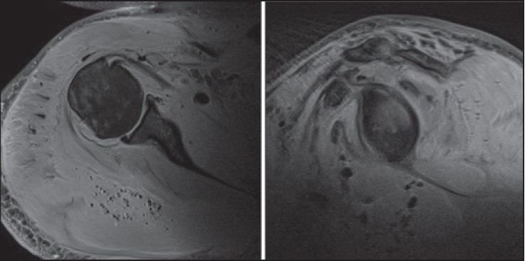 Figure 2: Axial and sagittal fat suppressed T2 weighted MR images displaying further high signal change within the muscle bellies in addition to low signal loculations of gas within the soft tissues
