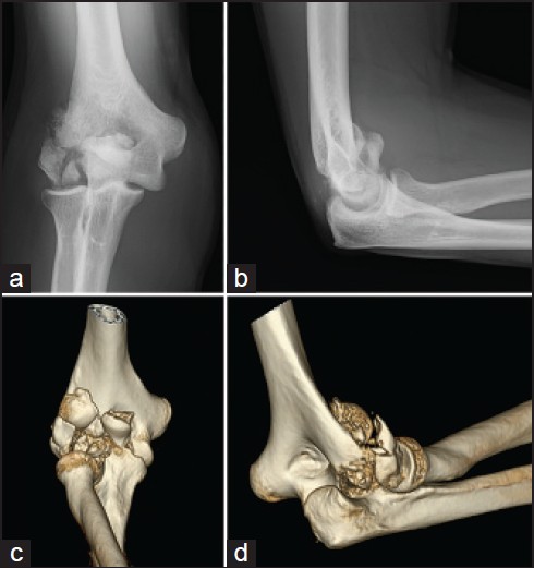 Figure 1: Lateral column shear fracture with subluxation of the ulnohumeral joint (a) Articular fragments including trochlea and capitellum (b and c) and conminution of the lateral column (d)