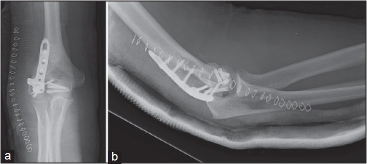 Figure 2: Postop X-ray, after reconstruction with the 