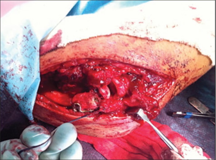 Figure 5: Step 3: Fixation of the capitellum over the graft and ligament repair