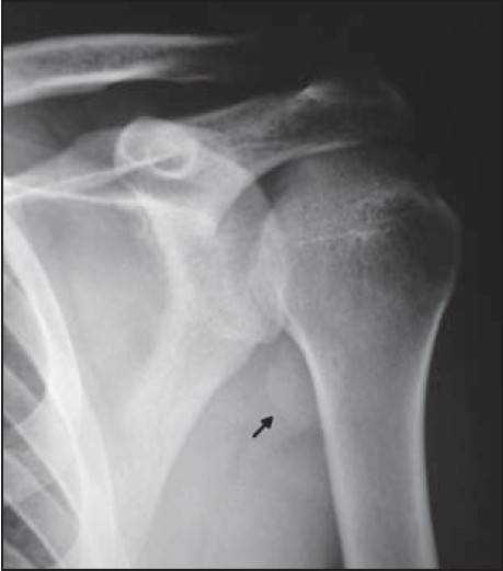 Figure 1: Preoperative anteroposterior X-ray of the shoulder showing the osteochondral fracture in the axillary pouch