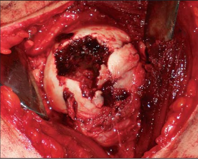 Figure 2: Intraoperative osteochondral defect of the humeral head
