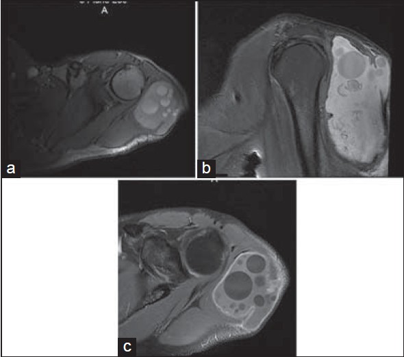 Figure 2: MRI aspects of T1 weighted axial image (a) and sagittal image (b) with fat suppression of the cyst, also T2-weighted coronal image shows the daughter cysts well (c)