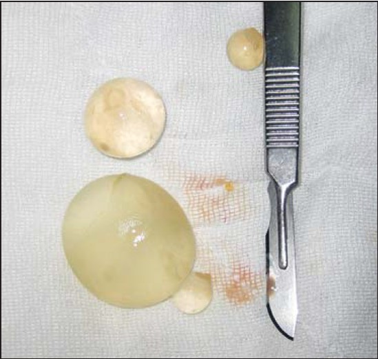 Figure 3: The mother and daughter cysts of the hydatid cyst were seen extracted in the surgery