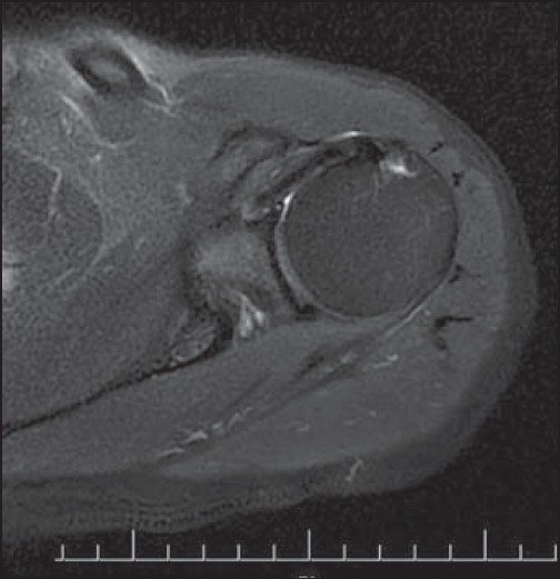 Figure 4: The cyst was completely disappeared after 2 years on an axial T1-weighted scan
