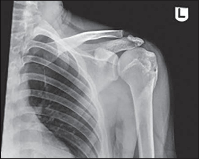 Figure 1: AP X-ray of shoulder at 3.5 months showing an ossifying mass coalescing with the proximal humerus