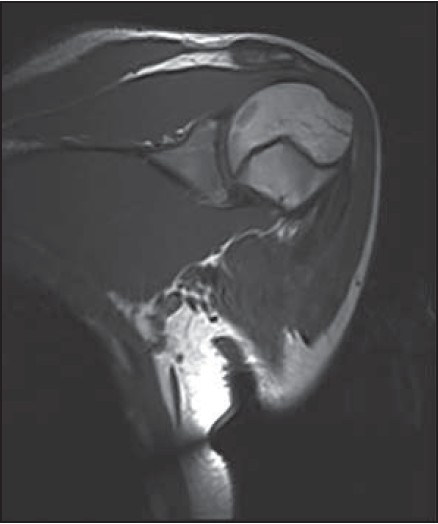 Figure 2: Coronal section MRI T1 at 3.5 months showing the zoning phenomenon