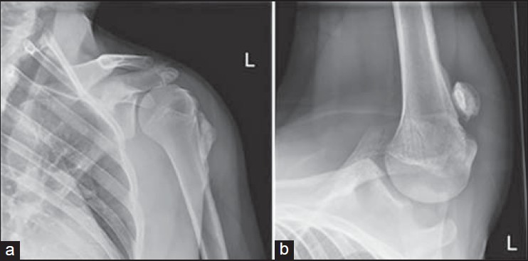 Figure 3: (A and B) AP and axial X-ray of shoulder at 5 months showing maturation of the ossifying mass