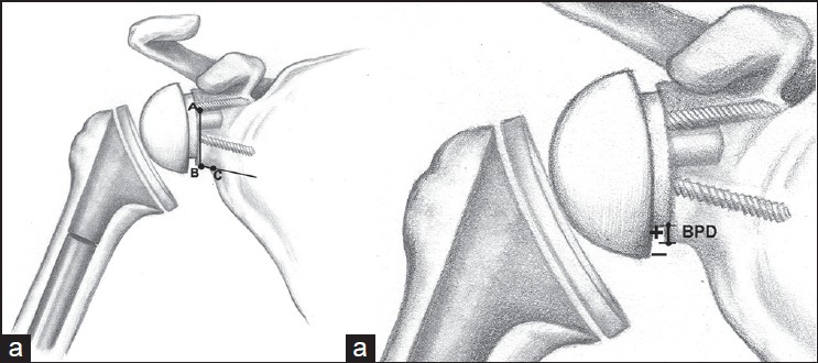 Figure 2: (a) Measurement of prosthesis-scapular neck angle (PSNA) and peg-glenoid rim distance (PGRD). The distance from A to B is the PGRD, and the angle AB to BC is the PSNA. (b) Measurement of base plate distance. Positive numbers denote placement of the glenoid baseplate above the inferior rim of the glenoid, negative numbers denote placement below the inferior rim of the glenoid
