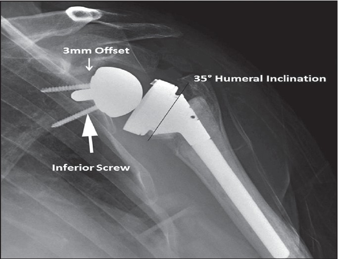 Figure 5: Clinical example of a baseplate placed on the inferior margin of the glenoid with an inferior trajectory of the screw. The screw penetrates the inferior neck of the scapula, possibly leading to inferior fixation as highlighted by the arrow. The baseplate has 3 mm of offset which is also illustrated, and the humeral inclination angle of 35° is also shown