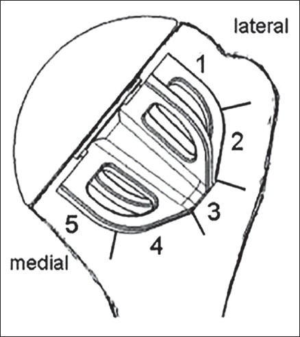 Figure 2: The five zones assessed for radiolucent lines around the short stem
