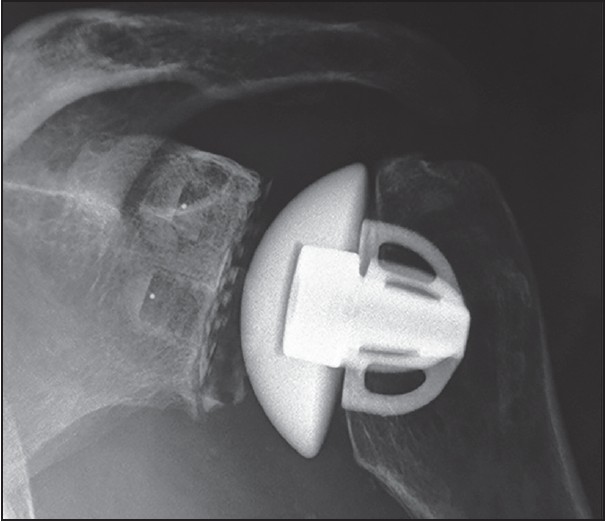 Figure 3: X-ray 2 years post-operative of an arthroplasty