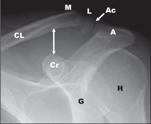 Figure 1: A 15° cephalad tilt radiograph of the glenohumeral joint shows a noncomminuted lateral clavicle fracture. Increased coracoclavicular distance (arrows) suggests disruption of the coracoclavicular ligaments. (Ac: acromioclavicular joint, A: acromion, CL: clavicle, M: medial fragment, L: lateral clavicle fragment, Cr: coracoid, G: glenoid, H: humeral head)