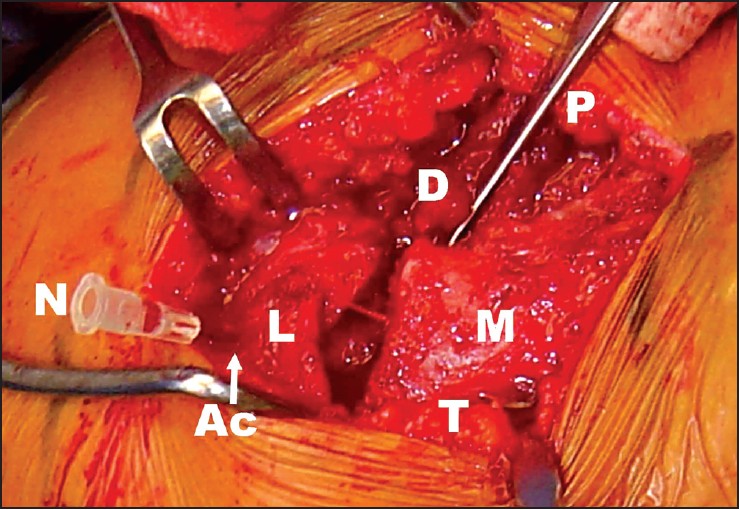 Figure 2: Intraoperative demonstration of the pathoanatomy of lateral clavicle fractures. A needle (N) marks the position of the acromioclavicular joint (Ac). The torn deltoid (D) and trapezius (T) attachments and the lateral (L) and medial (M) clavicular fragments are seen. A probe (P) is used to palpate the coracoid process