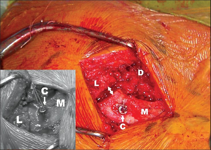 Figure 3: The coracoclavicular ligament repair device (C) reduces the medial fragment (M) to the level of the lateral fragment (L). Distraction of the fracture site (arrows) is seen when the arm is left unsupported. Inset: With the arm supported, the lateral and medial fragments are in apposition