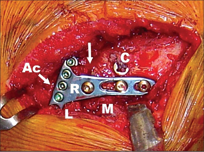 Figure 4: A five-hole locking radius plate (R) and the coracoclavicular fixation device (C) achieve adequate fixation of the fracture fragments (M and L) and apposition across the fracture site (Top arrow). (Ac: acromioclavicular joint)