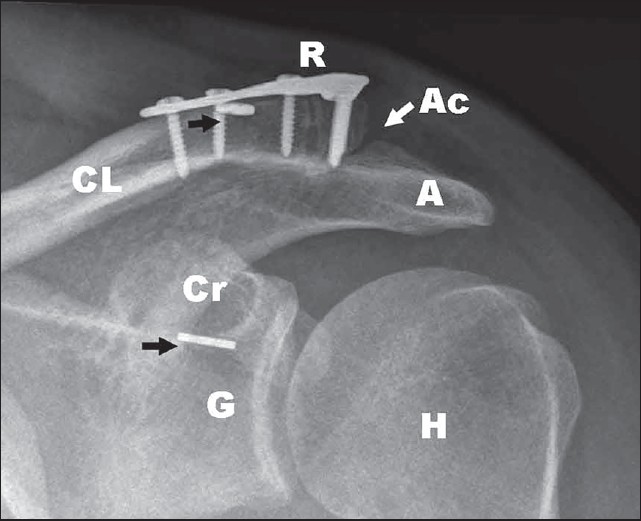 Figure 5: Follow-up radiograph shows signs of union across the fracture site (R: radius locking plate, Ac: acromioclavicular joint, A: acromion, CL: clavicle, Cr: coracoid, G: glenoid, H: humeral head, black arrows: coracoclavicular fixation device buttons)