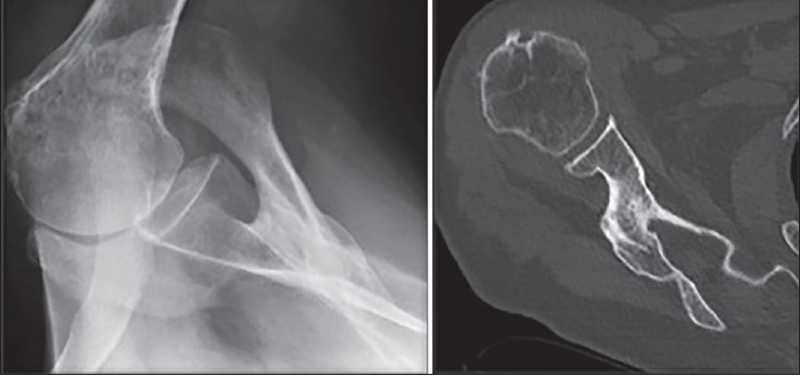 Figure 2: Radiograph (left) and computed tomography scan (right) of the right shoulder after conservative treatment showing evidence of callus formation and healing. This correlated well with clinical symptoms of reducing pain and improving function