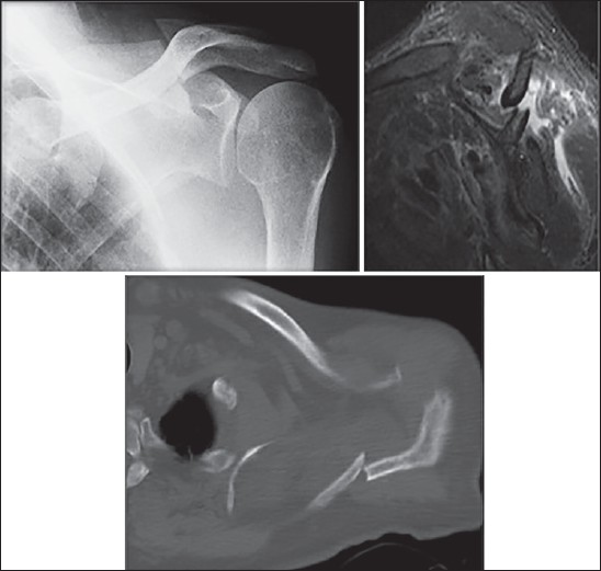 Figure 3: Radiograph (top left), magnetic resonance imaging (top right) and computed tomography (bottom) of the left shoulder showing evidence of nonunion of the scapula spine fracture, this correlated with persistent symptoms of pain and increased mobility at the fracture site