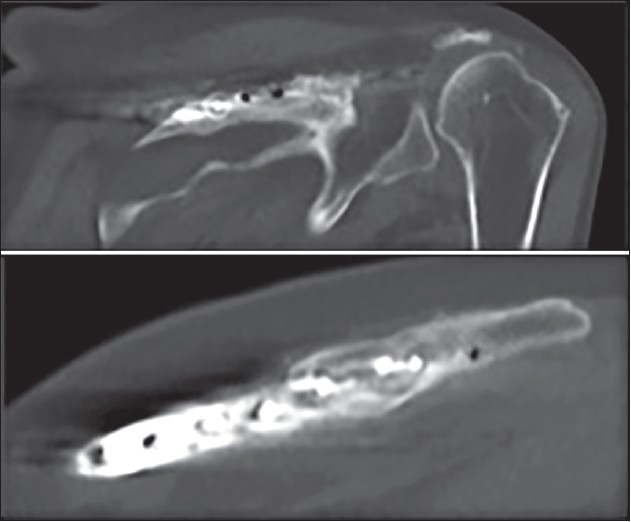 Figure 4: Follow-up computed tomography scan of the left shoulder at 2 years after open reduction and internal fixation with plates and screws showing bony union