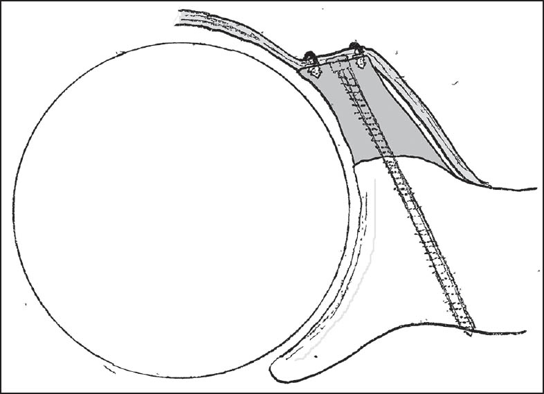 Figure 6: The suture anchors were used to create an intra-articular graft with repair of the labrum over the graft (seen here in an axial view)