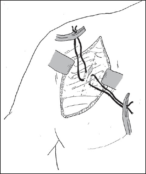 Figure 1: A standard deltopectoral incision was utilized with stay sutures attached to the subscapularis as it is incised and retracted to allow for later repair