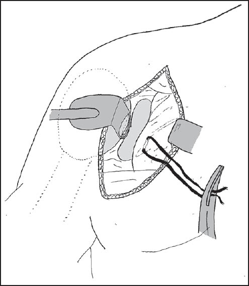 Figure 2: A Fukuda retractor is used to retract the humeral head to allow assessment of the glenohumeral articulation and measurement of glenoid bone loss