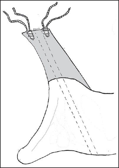 Figure 4: Two suture anchors were inserted into the glenoid (seen here in an axial view) at either ends of the allograft base to allow subsequent repair of the labrum