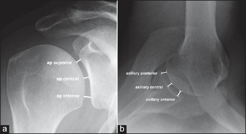 Figure 1: True (a) anteroposterior and (b) axillary view radiographs of the right shoulder illustrating the levels of joint space width measurement: Superior, central, and inferior anteroposterior in the coronal plane and anterior, central, and posterior axillary in the transverse plane. Measurements were made perpendicular to the articular surface