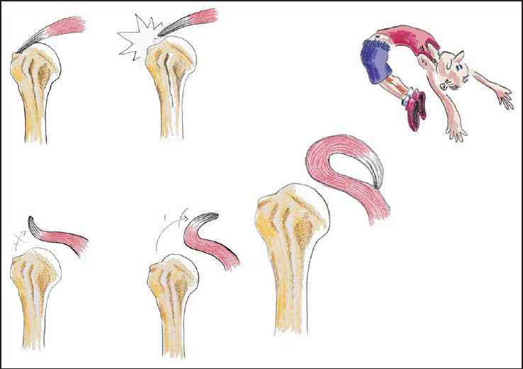 Figure 1: Arthroscopic view of a right shoulder through lateral portal after bursectomy and creation of a bone socket for medial row anchor placement. The supraspinatus tendon unusually thick and has the appearance of ulcerations and flanges of the bursal-side (H = Hole of the tap; HH = Humeral head; SS = Supraspinatus tendon)