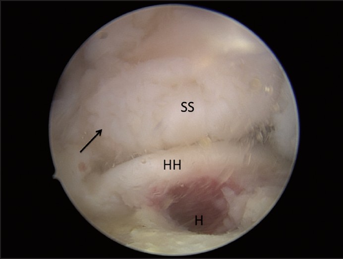 Figure 2: Arthroscopic view of a right shoulder viewed from lateral portal demonstrates a complete single row repair of the posterosuperior rotator cuff following mobilization of a Fosbury flop tear