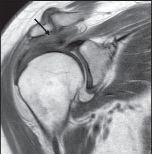 Figure 3: Coronal intermediate weighted image without fat saturation of a right shoulder that demonstrate (black arrow) an abnormally thickened supraspinatus (9.5 mm)