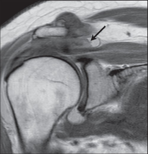 Figure 4: Coronal intermediate weighted image without fat saturation that shows the tendon stump projecting on top of the superomedial part of the subacromial bursa. A two-layered structure with the stump is clearly differentiated
