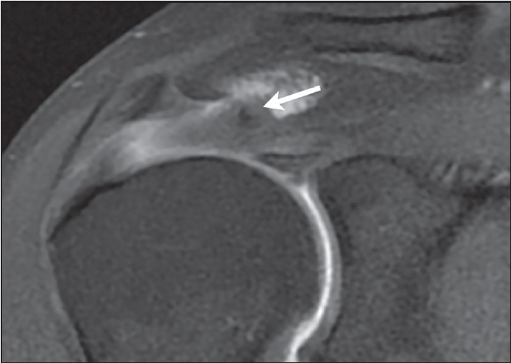 Figure 5: Coronal T1-weighted with fat saturation of a right shoulder. Adherences between the bursal tendon side and the wall of the subacromial bursa, fluid in the subacromial bursa, and abnormal orientation of the fibers in the tendon stump (write arrow) are noted
