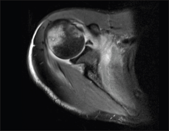 Figure 1: Presenting magnetic resonance imaging showing small cystic area posteriorly features would be consistent with osteomyelitis with a tiny intraosseous collection (original)