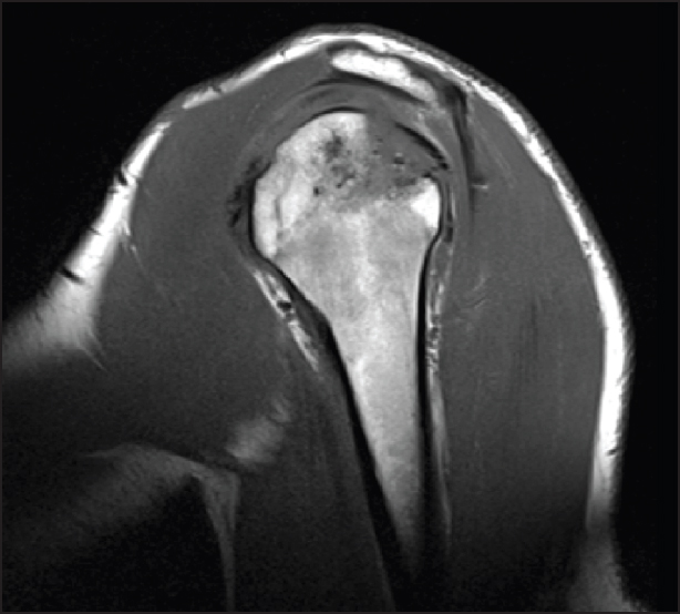 Figure 2: Follow-up magnetic resonance imaging after completion of treatment demonstrating partial collapse of the posterior superior humeral head (original)
