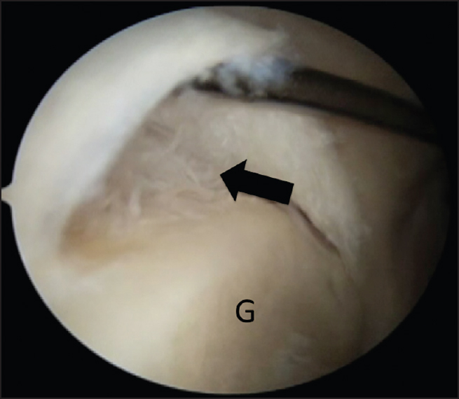 Figure 1: Arthroscopic view of the right shoulder demonstrating a type II SLAP lesion with an increased sublabral sulcus, a bare sublabral footprint and evidence of fiber failure (arrow). G: Glenoid