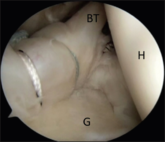 Figure 2: Arthroscopic view of a right shoulder demonstrating repair of a type II SLAP lesion with one suture anchor placed under the biceps root and a second anchor placed more posteriorly. BT: Biceps tendon, G: Glenoid, H: Humeral head