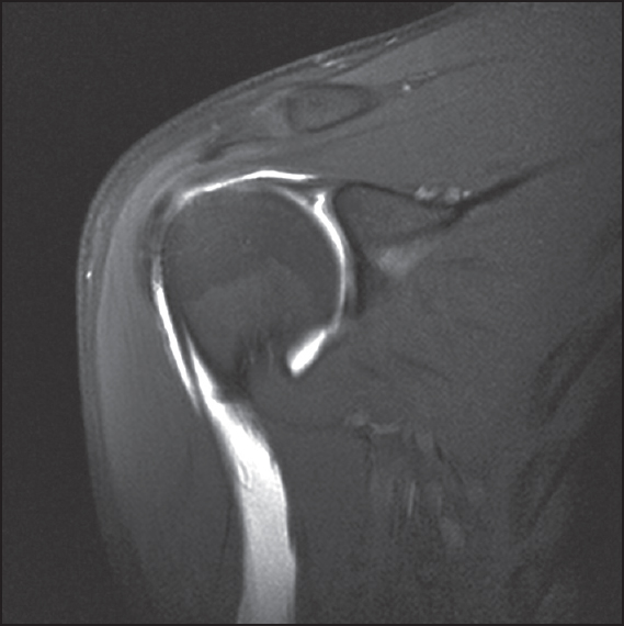 Figure 3: T1-weighted, fat-suppressed, coronal oblique magnetic resonance imaging arthrography images demonstrating a patient with a recurrent type II SLAP lesions following type II SLAP repair. Note the high signal (gadolinium) present between the superior labrum and glenoid present postoperatively