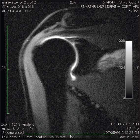 Figure 4: T1-weighted, fat-suppressed, coronal oblique magnetic resonance imaging arthrography images demonstrating a patient with an intact superior labrum following type II SLAP repair. Note the absence of gadolinium between the superior labrum and glenoid postoperatively