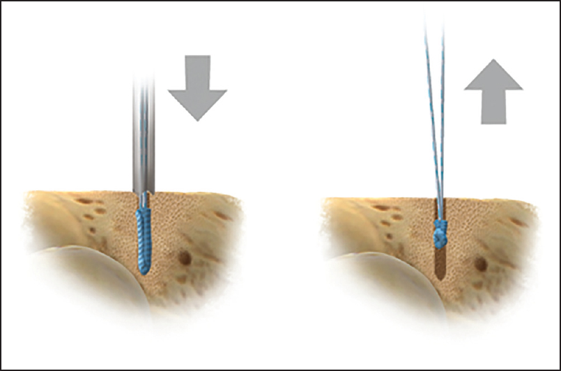 Figure 1: JuggerKnot Soft Anchor inserted into bone hole (left) and after removal of inserter and tugging on suture legs to set device (right)
