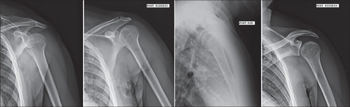 Figure 1: Rx left shoulder: In the first image dislocated shoulder immediately after the trauma. In subsequent images: Rx control of the left sholder after reduction.