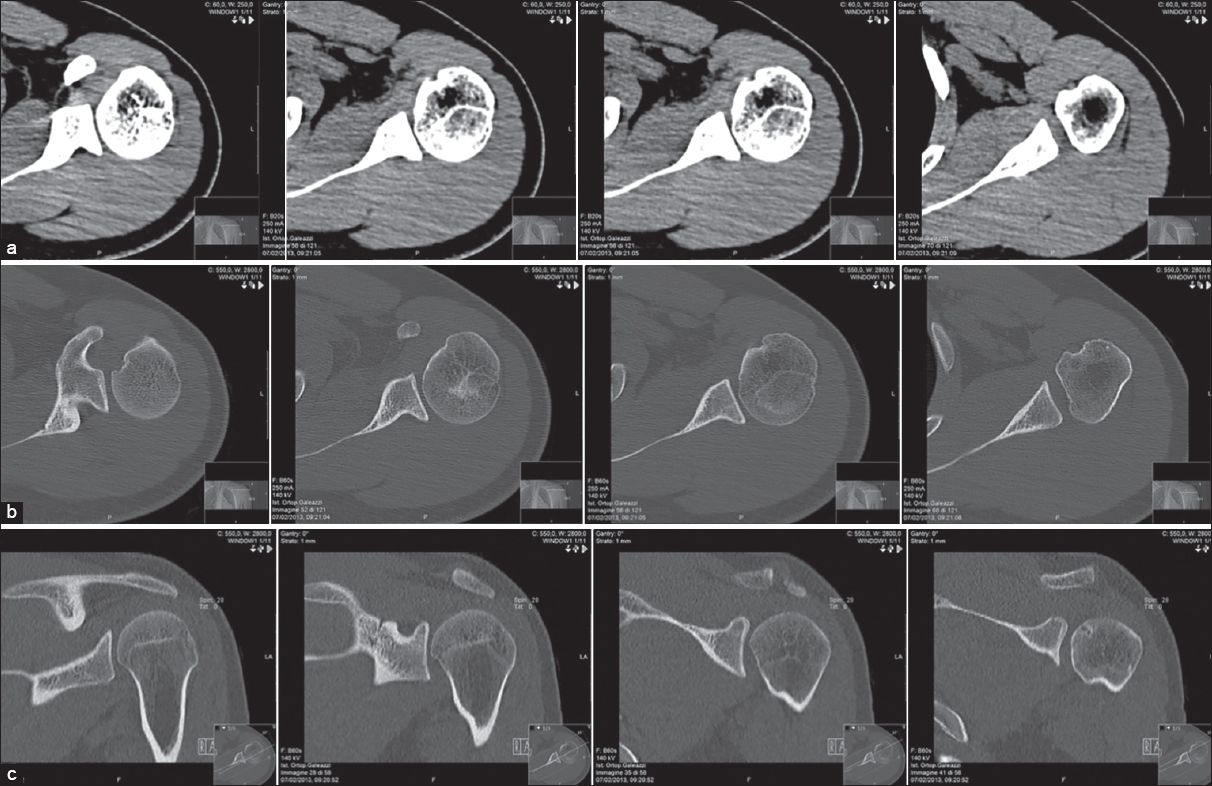 Figure 2: Pre-operative computed tomography images. Axial and sagittal view. Left shoulder: humeral head that presents focal cortical erosion with small subcortical cystic-dystrophic irregularities along the anterior superior medial side. Incision of the profi le cortex of the humeral head on the rear side. (a-b) Axial view (c) sagittal view