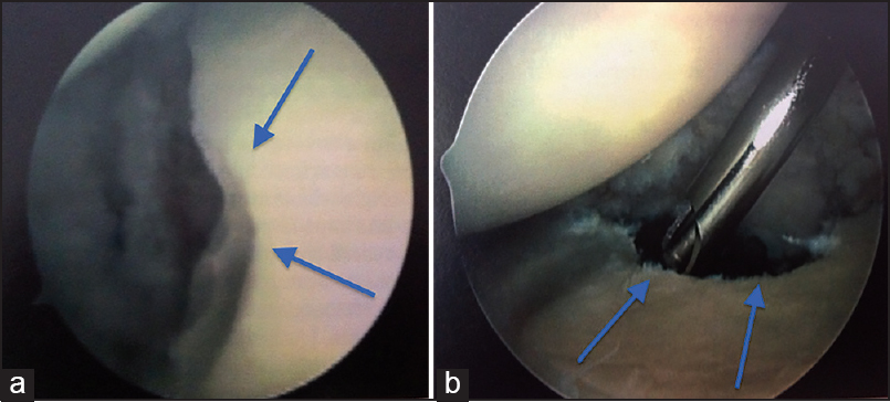 Figure 3: Arthroscopic view of the glenoid bone defect. (a) Anterior portal (b) posterior portal