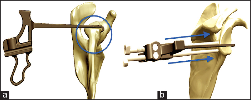 Figure 5: (a)The guide is rotated to capture the anterior edge of the glenoid under the hook. The hook should be placed at the 4 o'clock position which will correlate with the mid point of the coracoid. The Glenoid Guide should also align with the placement of the spinal needle. (b) Once the hook is positioned, a bullet is placed in the superior hole of the guide. A small skin incision is made and the bullet is advanced until it firmly contacts the posterior aspect of the glenoid neck. The ratchet teeth of the bullet should be aligned with the screws adjacent to the handle of the guide. The process is repeated for the inferior bullet.