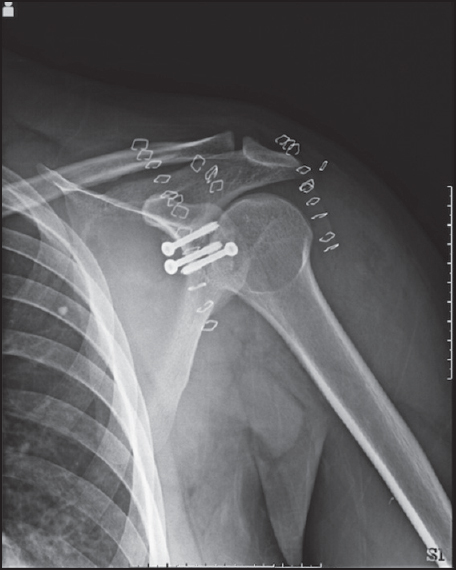 Figure 7: Antero-posterior Rx image, left shoulder. Day after surgery. Correct anterior coracoid and posterior bone graft positioning
