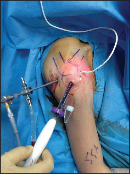 Figure 1: Standard two arthroscopic portals were used in all cases, and fiber-optic temperature probe was placed in the subacromial bursa through an extra anterior portal