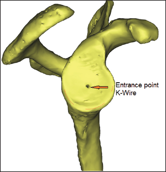 Figure 10: The entrance point of the K-wire in the center of the glenoid component
