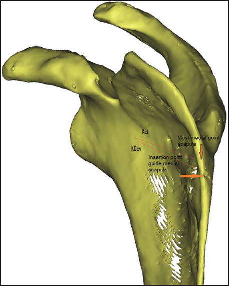 Figure 11: View of the medial side of the scapula with the insertion point of the glenoid aiming device. In this case, the most medial point of the scapula is slightly higher. The lines Kct (virtual kirschner pinning) and KDev (kirschner pinning with the device)
