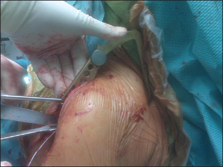 Figure 12: The use of the glenoid aiming device in practice
